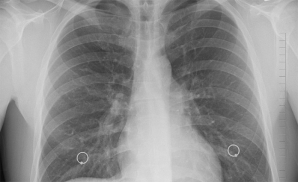 Plicní lékaři odhalili v Libereckém kraji 10 nemocných 